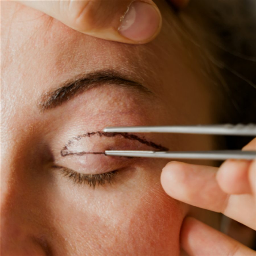Blepharoplasty in Jalandhar consultation at Beyond Aesthetix Jalandhar