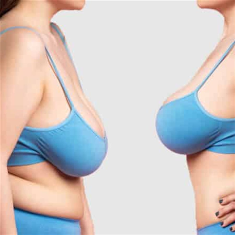 Breast Reduction in Jalandhar consultation at Beyond Aesthetix Jalandhar