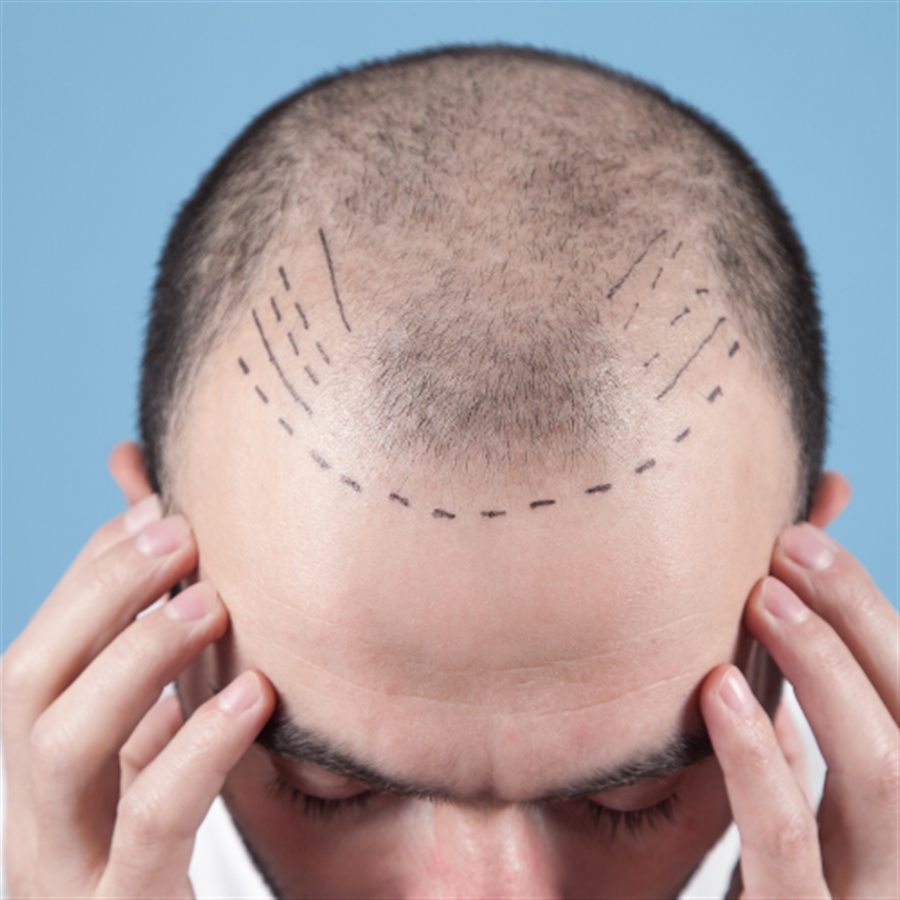 Hair Transplant in Jalandhar consultation at Beyond Aesthetix Jalandhar