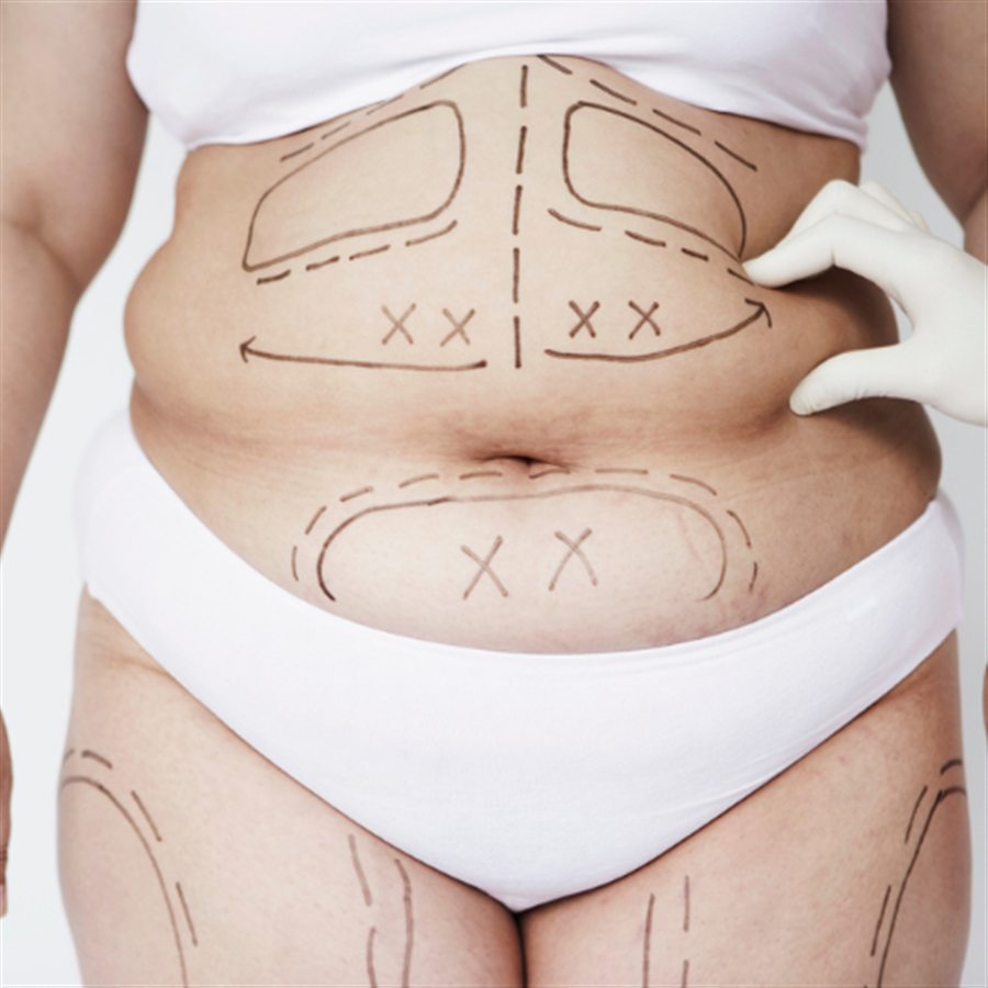 Liposuction in Jalandhar consultation at Beyond Aesthetix Jalandhar