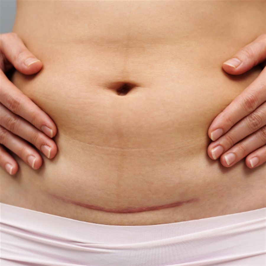 Scar Revision in Jalandhar consultation at Beyond Aesthetix Jalandhar